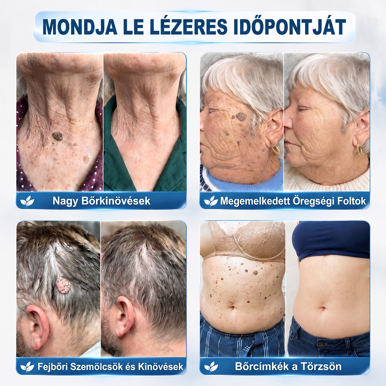 🎁🎁🎁HISKIN® Már csak 5 doboz maradt! Élvezd a további 30% kedvezményt! Távolítsd el a szemölcsöket, javítsd ki a bőrhibákat, és nyerd vissza a tiszta, sima bőrt! Ne hagyd ki ezt a lehetőséget, ez az ajánlat jövőre már nem érvényes.