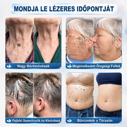 🎁🎁🎁HISKIN® Már csak 5 doboz maradt! Élvezd a további 30% kedvezményt! Távolítsd el a szemölcsöket, javítsd ki a bőrhibákat, és nyerd vissza a tiszta, sima bőrt! Ne hagyd ki ezt a lehetőséget, ez az ajánlat jövőre már nem érvényes.