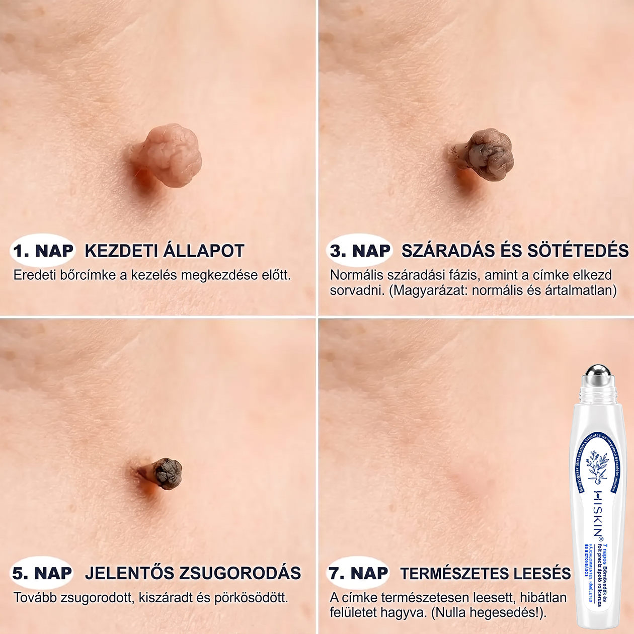 🎁🎁🎁HISKIN® Már csak 5 doboz maradt! Élvezd a további 30% kedvezményt! Távolítsd el a szemölcsöket, javítsd ki a bőrhibákat, és nyerd vissza a tiszta, sima bőrt! Ne hagyd ki ezt a lehetőséget, ez az ajánlat jövőre már nem érvényes.