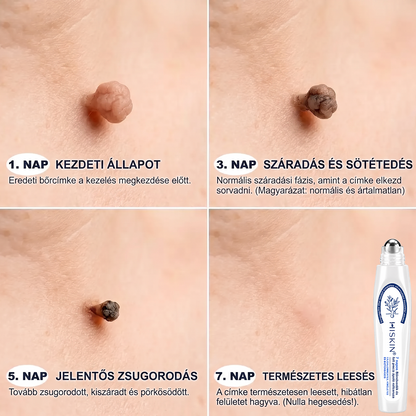 🎁🎁🎁HISKIN® Már csak 5 doboz maradt! Élvezd a további 30% kedvezményt! Távolítsd el a szemölcsöket, javítsd ki a bőrhibákat, és nyerd vissza a tiszta, sima bőrt! Ne hagyd ki ezt a lehetőséget, ez az ajánlat jövőre már nem érvényes.