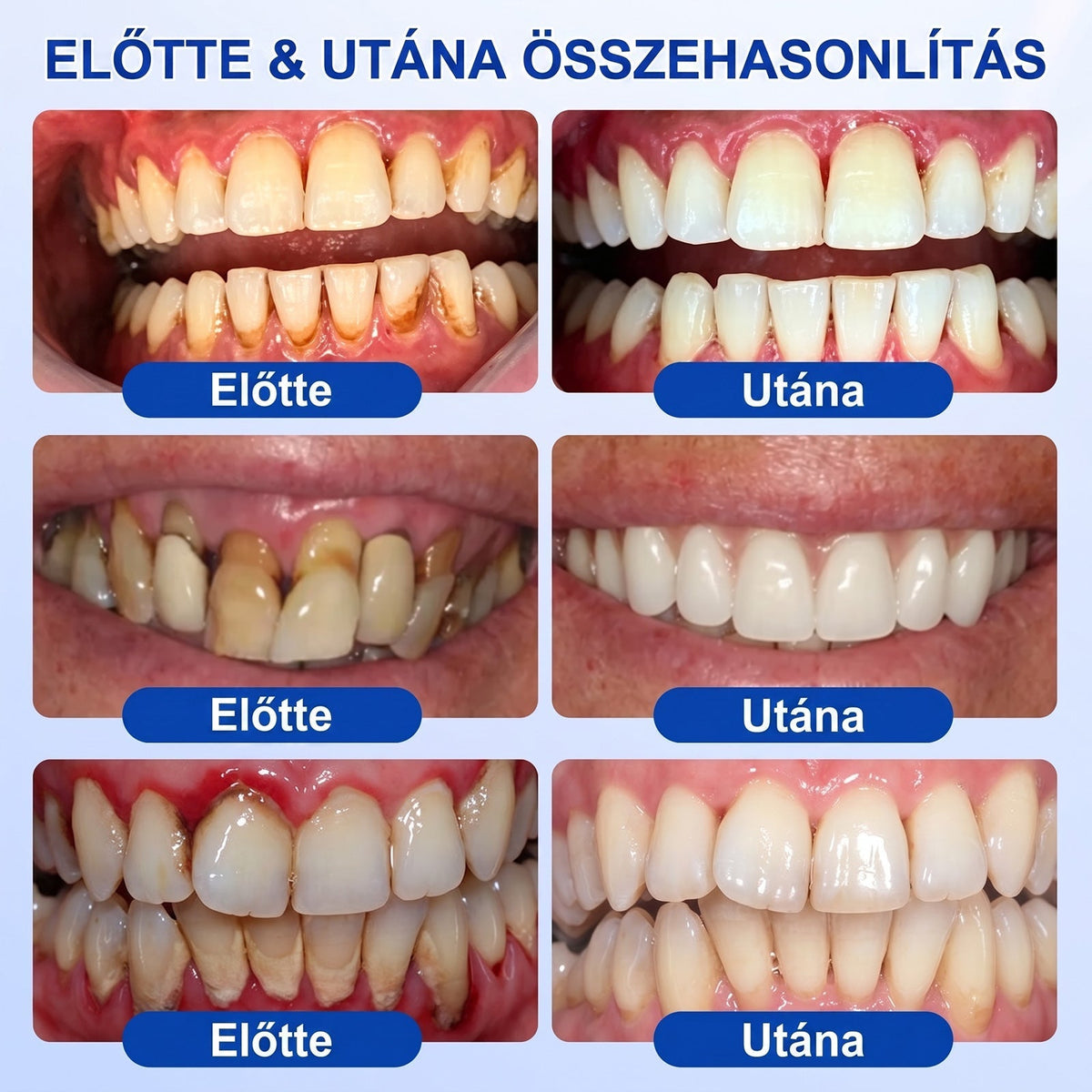 🦷 Dr.Era® GumRevive fogíny- és parodontális regeneráló gél 📬— Célzott ápolás az ínyszélen lepedék, fogszuvasodás, fogágyproblémák, kellemetlen lehelet és meggyengült fogak esetén | Precízen alkalmazható, leöblítést nem igénylő szájápoló formula